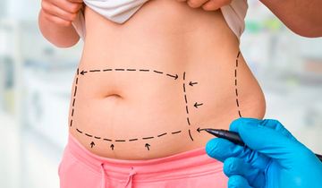 Cirugía de abdominoplastia